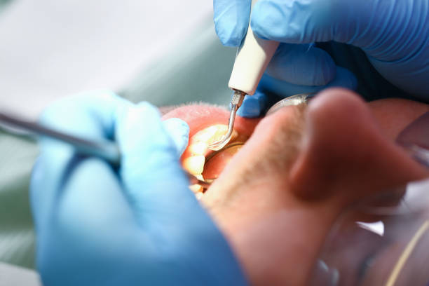 Best Emergency Dental Extractions in West Miami, FL